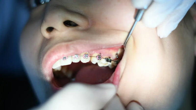 Come pulire i denti con l'apparecchio fisso: guida completa