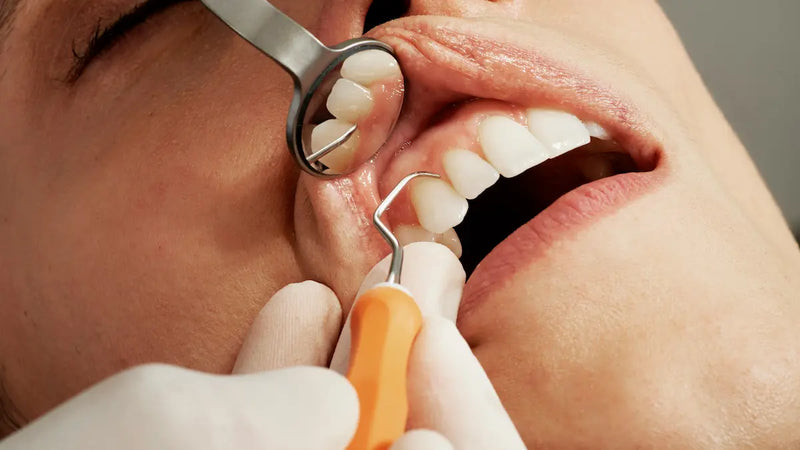 Yellow teeth: causes, remedies, and professional whitening
