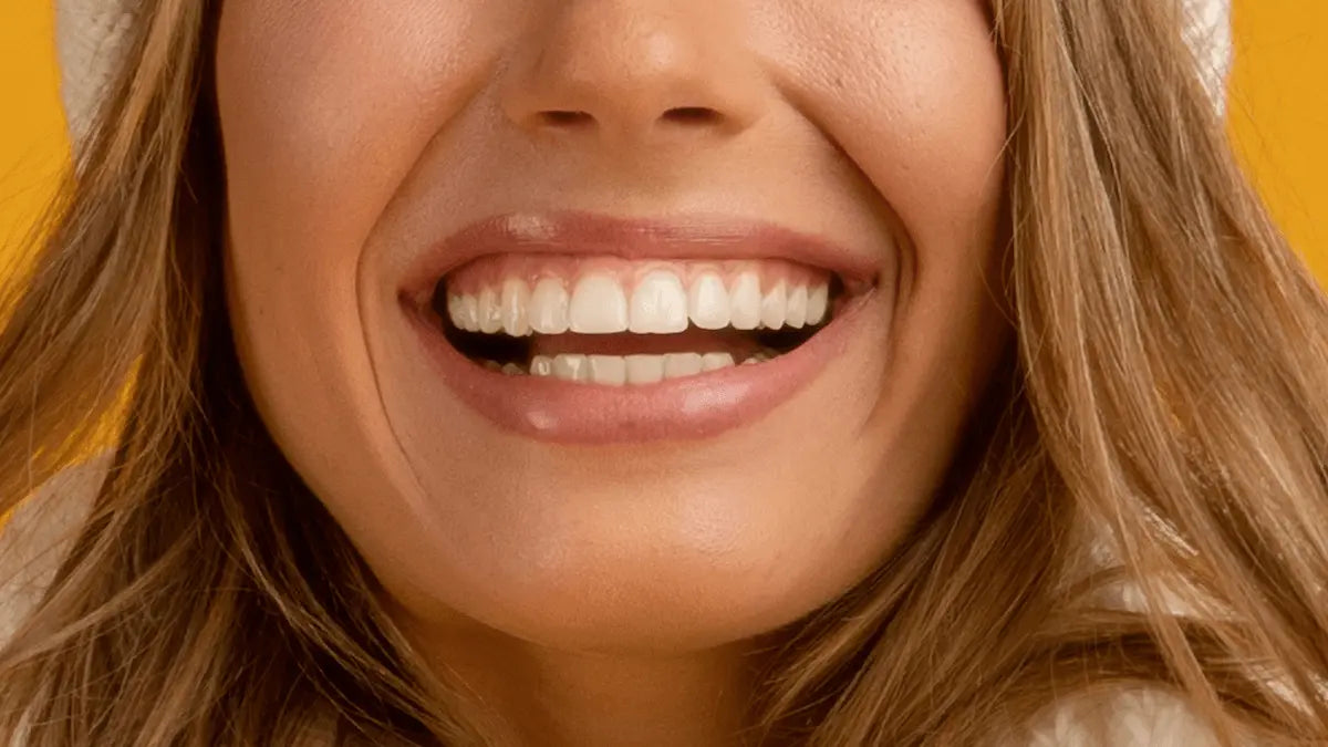 Faccette Dentali: Cosa Sono, Quando Metterle e Quanto Durano